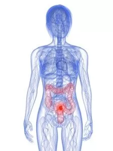 collocazione del tumore al colon